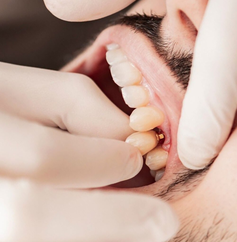 implante-dentário-instalação-de-implante-cirurgia-de-implante-implantodontia-reabilitação-oral-procedimento-odontológico-saúde-bucal