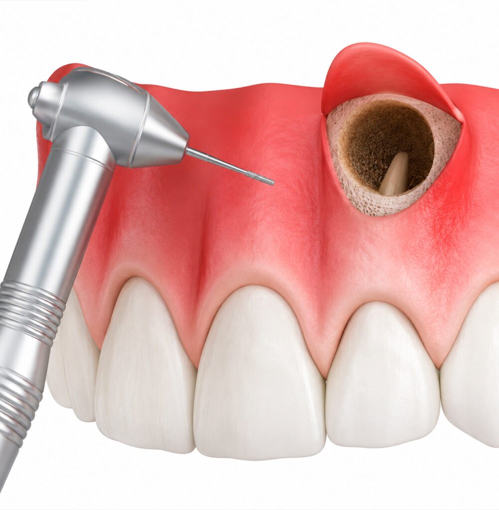 cirurgia-parendodôntica-microcirurgia-endodôntica-apicectomia-tratamento-endodôntico-cirurgia-odontológica-saúde-bucal-endodontia