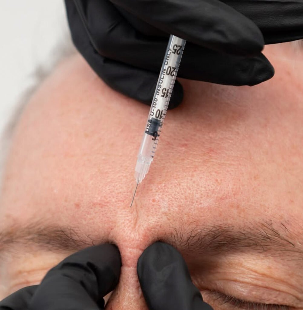 toxina-botulínica-aplicação-facial-botox-harmonização-facial-estética-facial-procedimento-estético-rejuvenescimento-facial