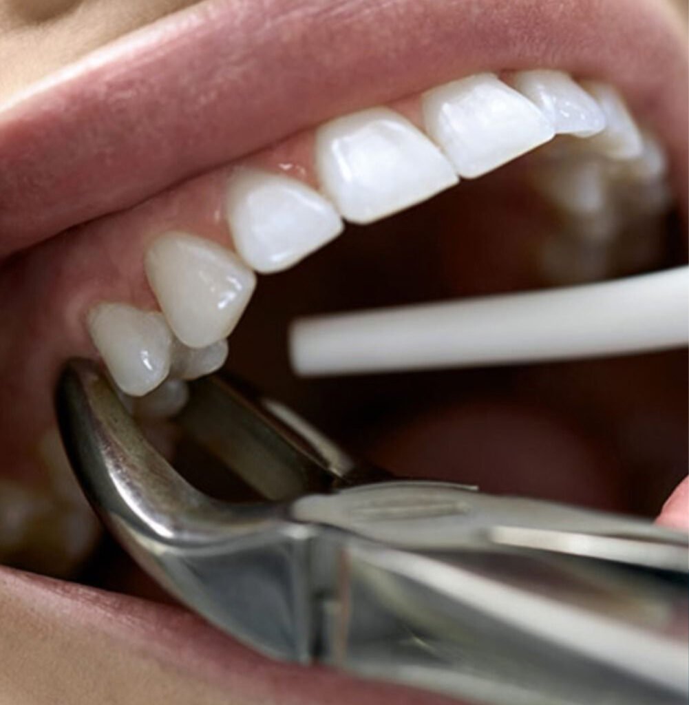 cirurgia-oral-menor-extração-dentária-exodontia-procedimento-cirúrgico-cirurgia-bucal-dentista-saúde-bucal