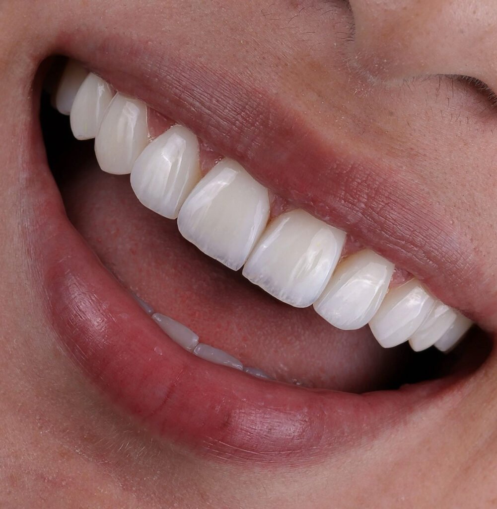 facetas-em-resina-estética-dental-lentes-em-resina-reabilitação-estética-sorriso-harmonioso-dentística-restauradora-odontologia-estética