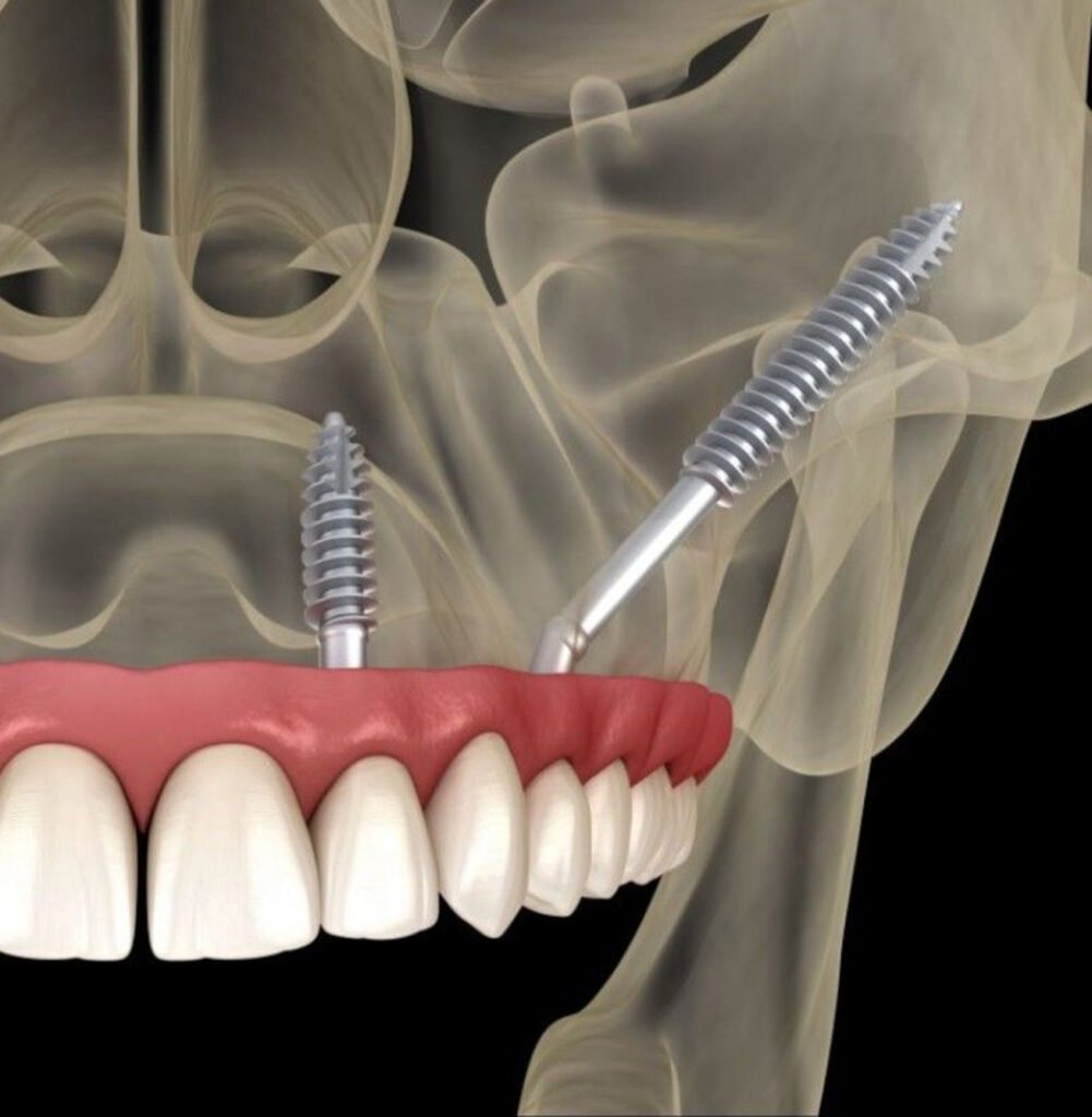 prótese-sobre-implante-implantes-dentários-reabilitação-oral-prótese-protocolo-implantodontia-planejamento-odontológico-saúde-bucal