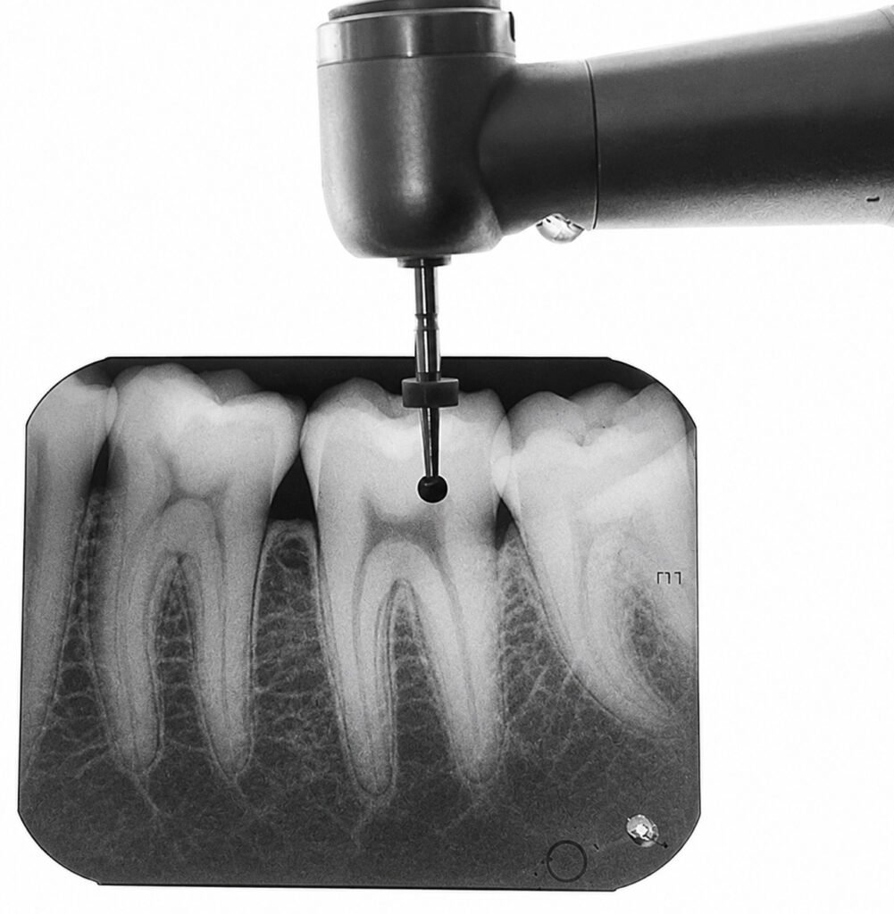endodontia-digital-localizador-apical-radiografia-odontológica-tratamento-de-canal-diagnóstico-endodôntico-procedimento-odontológico-saúde-bucal