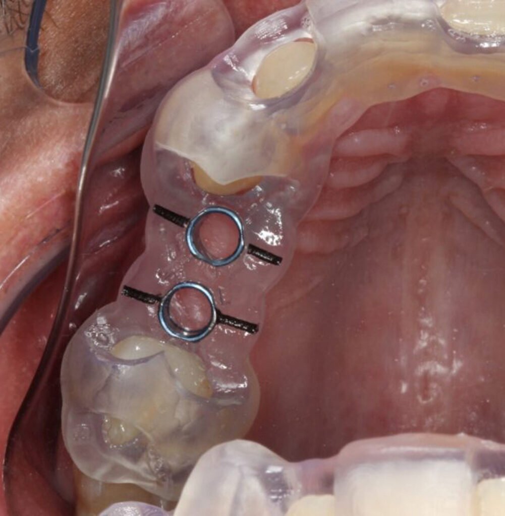 implante-dentário-cirurgia-guiada-guia-cirúrgico-planejamento-digital-reabilitação-oral-implantodontia-odontologia