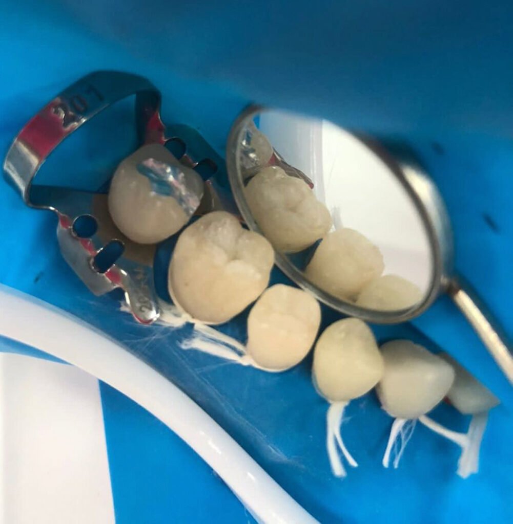 dentística-restauradora-restauração-em-resina-isolamento-absoluto-procedimento-odontológico-reabilitação-dental-estética-dental-saúde-bucal