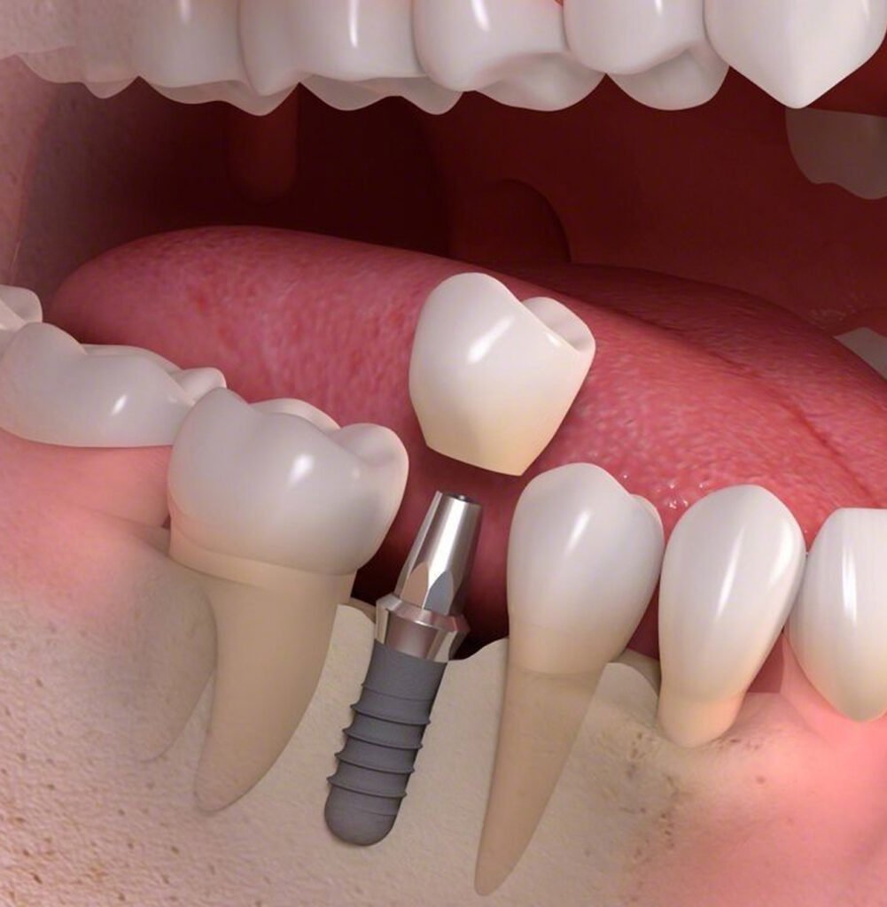 implante-dentário-prótese-sobre-implante-reabilitação-oral-implantodontia-coroa-dentária-saúde-bucal-tratamento-odontológico